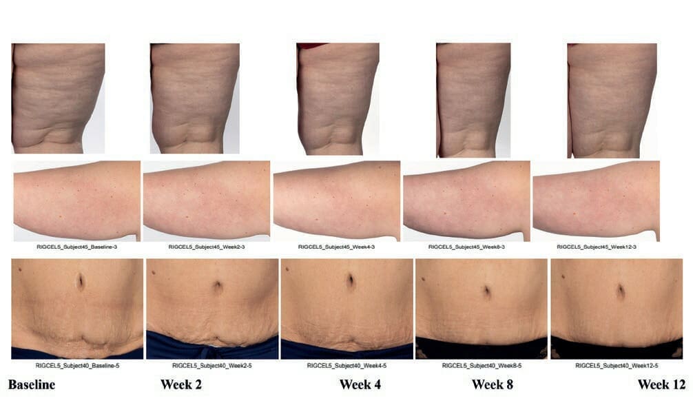 Clinical improvement of appearance of cellulite and skin characteristics with a non-invasive biphasic pulsed microcurrent device system 20 EURO COSMETICS Magazine • Clinical improvement of appearance of cellulite and skin characteristics with a non-invasive biphasic pulsed microcurrent device system • Melanie Riggs, K.C. Holley, Helen Knaggs1, Steve Powell, Brian Cook, Ganesh Diwakar • Melanie Riggs, K.C. Holley, Helen Knaggs1, Steve Powell, Brian Cook, Ganesh Diwakar