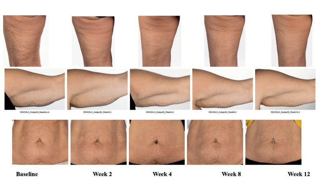 Clinical improvement of appearance of cellulite and skin characteristics with a non-invasive biphasic pulsed microcurrent device system 18 EURO COSMETICS Magazine • Clinical improvement of appearance of cellulite and skin characteristics with a non-invasive biphasic pulsed microcurrent device system • Melanie Riggs, K.C. Holley, Helen Knaggs1, Steve Powell, Brian Cook, Ganesh Diwakar • Melanie Riggs, K.C. Holley, Helen Knaggs1, Steve Powell, Brian Cook, Ganesh Diwakar