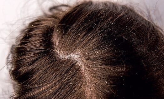 Exploring the Relationship Between the Scalp Microbiome and Dandruff 3 EURO COSMETICS Magazine • Exploring the Relationship Between the Scalp Microbiome and Dandruff • Charlotte Vedel • Charlotte Vedel