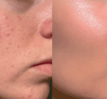 Skin Inflammaging: Barrier Repair, Cytokine Control and the Role of bitop Ectoin® natural 10 EURO COSMETICS Magazine • Skin Inflammaging: Barrier Repair, Cytokine Control and the Role of bitop Ectoin® natural • Gerhard Schubert GmbH • Gerhard Schubert GmbH